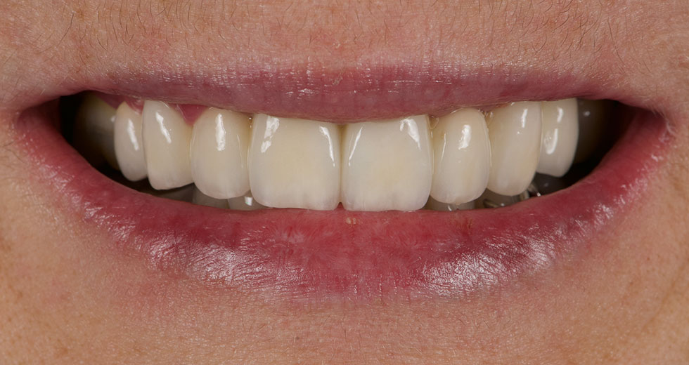 plusieurs dents manquantes après traitement