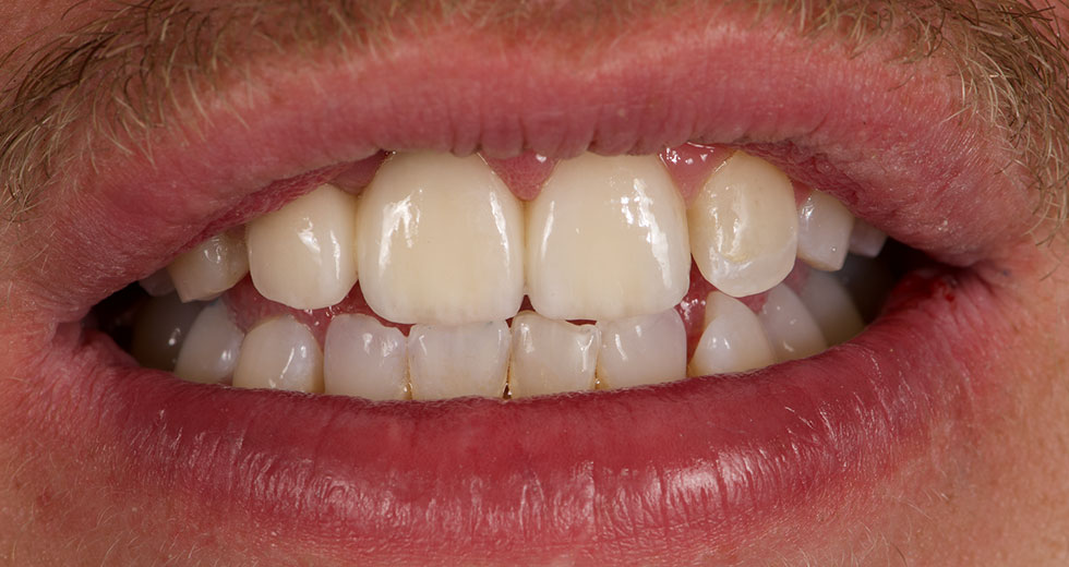 dentition après traitement de face