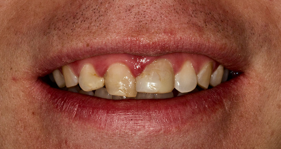 dentition avant traitement de face
