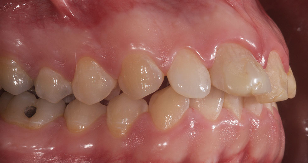 dentition avec plusieurs dents manquantes de côté