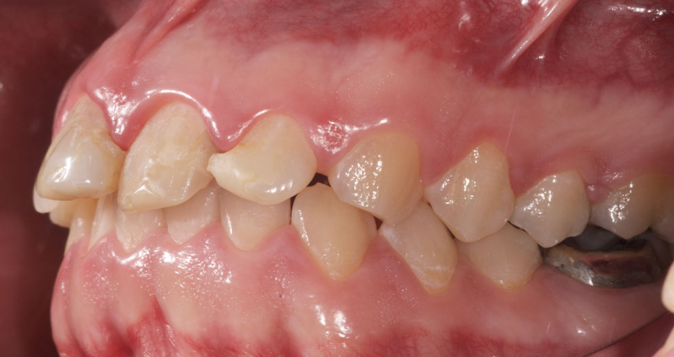 dentition avec plusieurs dents manquantes