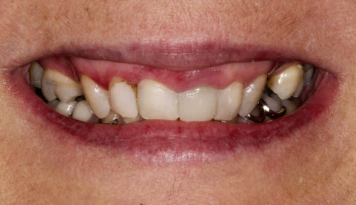 dentition avant traitement clinique Battah