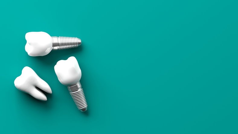 photo Quel prix devriez-vous payer pour un implant dentaire?