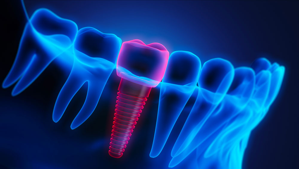 photo Quelles sont les différences entre un implant et une prothèse dentaire?